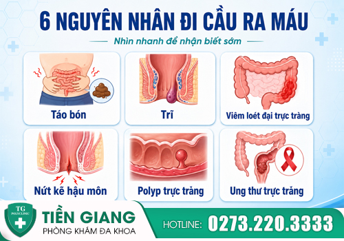 6 nguyên nhân dẫn tới đi cầu ra máu