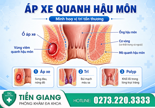 áp xe hậu môn khiến người bệnh đau đớn khổ sở