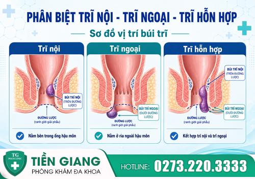 Bệnh trĩ là nguyên nhân phổ biến gây đi cầu ra máu